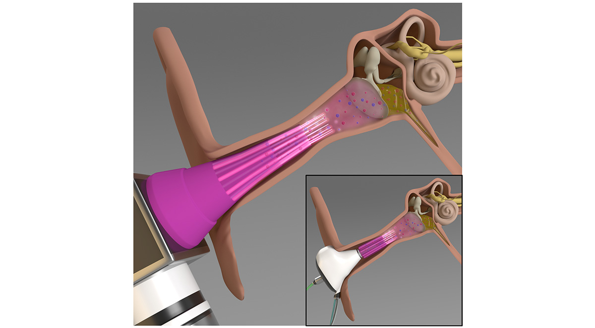 An illustration of the cold plasma-integrated otoscope (main figure) and the earbud (inset) for the potential treatment of middle ear infections. 
