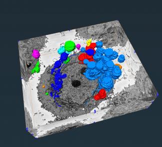 The image shows a 3D stack of SBF-SEM images of human pancreatic neuroendocrine cancer cells undergoing autophagy dependent cell death. Chloroquine inhibits autophagy by inhibiting the degradation of autolysosome. This 3D image clearly shows that accumulation of autophagic vacuoles (autophagosome and autolysosome) were detected in chloroquine treated BON (human pancreatic neuroendocrine cancer) cells. The image was taken using SBF-SEM at the Carle R. Woese Institute for Genomic Biology’s core facilities 