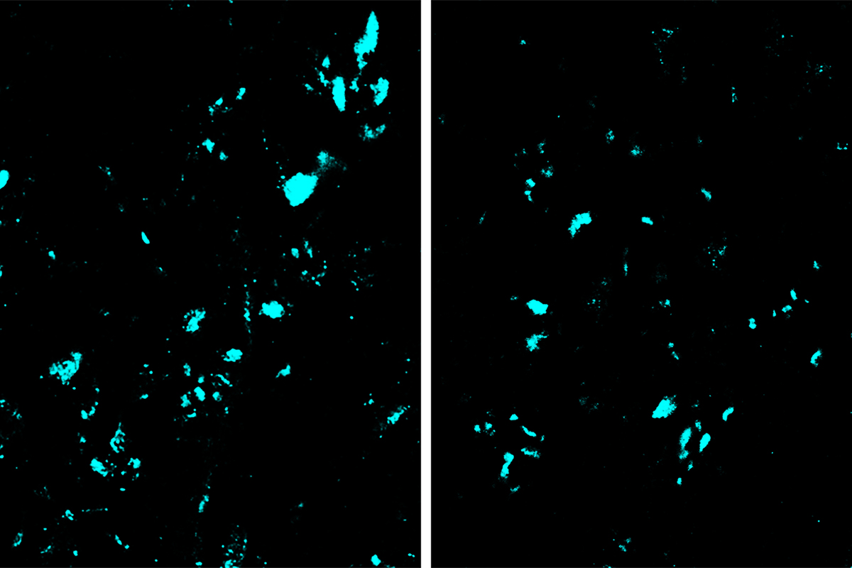 CRISPR base editing decreased the amount of a mutant protein (blue) that contributes to ALS in the spinal cord. Left, a spinal cord section from an untreated mouse. Right, a spinal cord section from an animal treated by base editing.