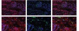 Cross sections of breast tumors showing that myeloid cells (green) are able to express the gene ABCA1 (red), which helps activate cancer-fighting properties. Other types of cells are labeled with blue.