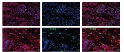 Cross sections of breast tumors showing that myeloid cells (green) are able to express the gene ABCA1 (red), which helps activate cancer-fighting properties. Other types of cells are labeled with blue.