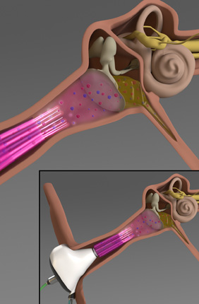 An illustration of the cold plasma-integrated otoscope (main figure) and the earbud (inset) for the potential treatment of middle ear infections. 