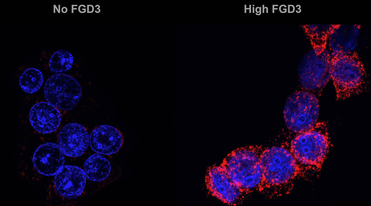 In human breast cancer cells treated with the preclinical drug ErSO (shown), or with doxorubicin, the cellular protein FGD3 causes another protein, calreticulin (in red on the right), to display on the cancer cell surface, attracting and activating immune cells. Micrographs by Junyao Zhu
