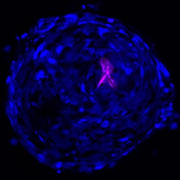 When Brain Thinks of Breast Cancer