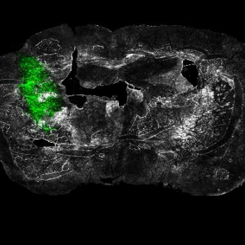 "Ex vivo coronal section of glioma cells, labeled with GFP (green), in a mouse model of glioblastoma (GBM) on day 14 of tumor development."