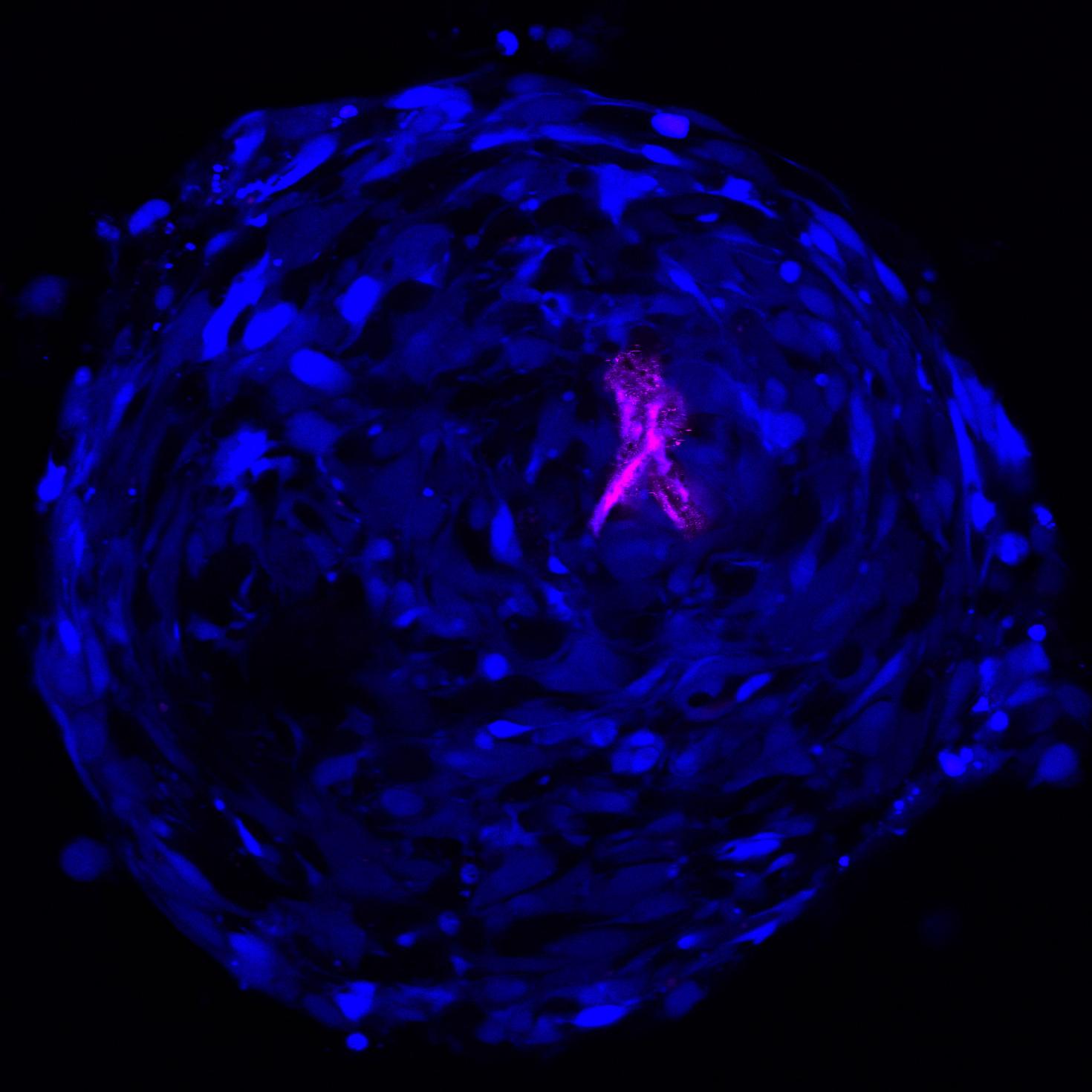 When Brain Thinks of Breast Cancer