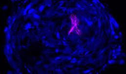 When Brain Thinks of Breast Cancer