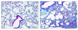 On the left, healthy mouse lung tissue. On the right, corisin-affected lung tissue shows extensive fibrosis. Image courtesy Esteban Gabazza