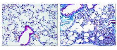 On the left, healthy mouse lung tissue. On the right, corisin-affected lung tissue shows extensive fibrosis. Image courtesy Esteban Gabazza