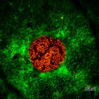 “This is a SHG image of a FET colorectal cancer cell spheroid embedded in a 3D type-I collagen gel. The nuclei of the cancer cells at the center are stained with DAPI. This experiment shows how cancer spheroids reorganize collagen fibers around them through mechanical interaction with the fibers.”