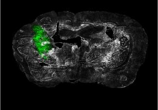 "Ex vivo coronal section of glioma cells, labeled with GFP (green), in a mouse model of glioblastoma (GBM) on day 14 of tumor development."