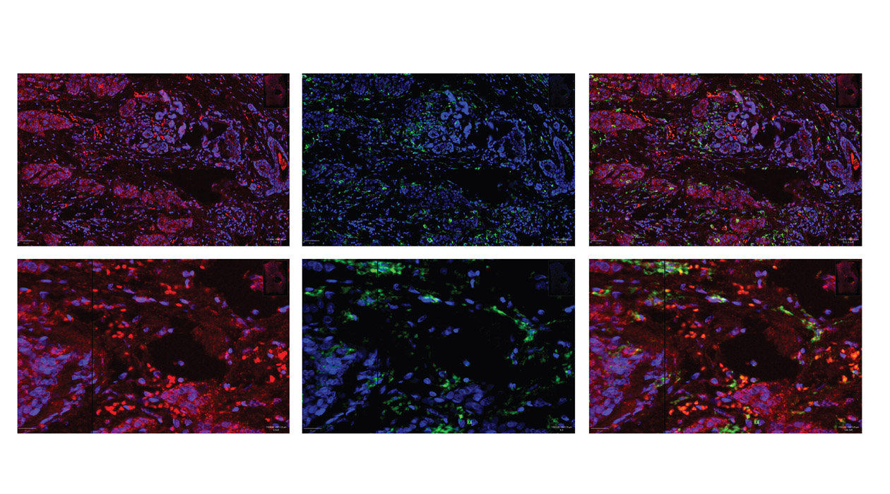 Cross sections of breast tumors showing that myeloid cells (green) are able to express the gene ABCA1 (red), which helps activate cancer-fighting properties. Other types of cells are labeled with blue.