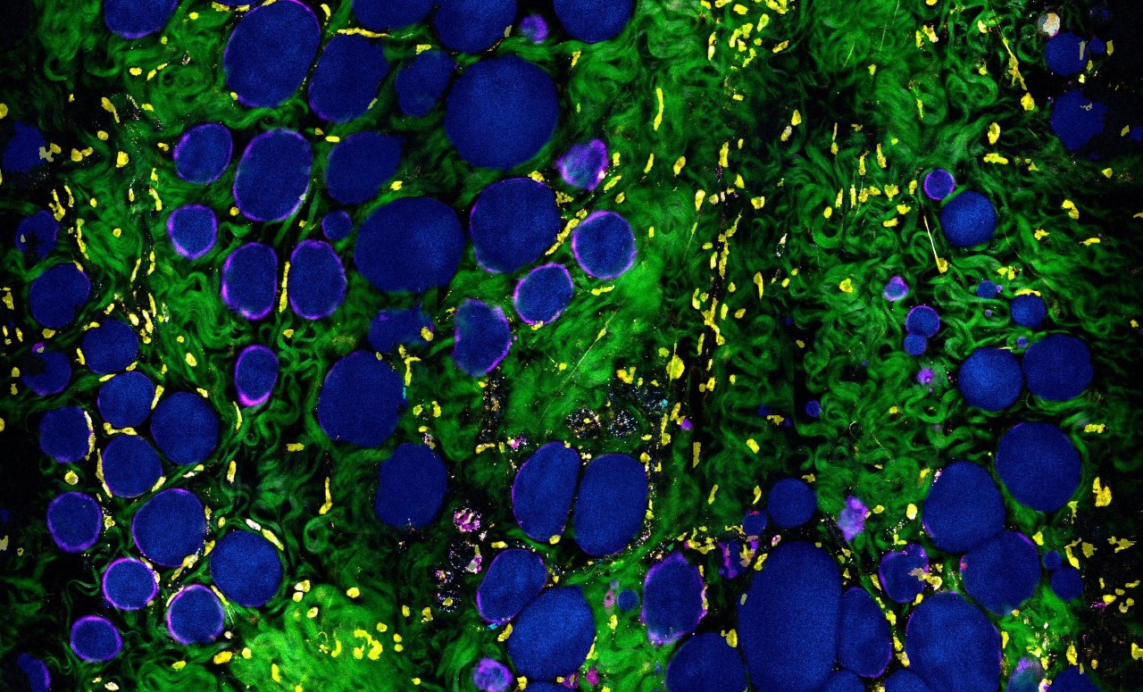 Label-free multiphoton imaging enables visualization of normal and malignant living cells in their native tissue microenvironment. In the image of normal tissue obtained from a control rat, the saturated colors represent the segmentation mask that is overlaid with the original label-free image. Navy blue, adipocytes; yellow, stromal cells.