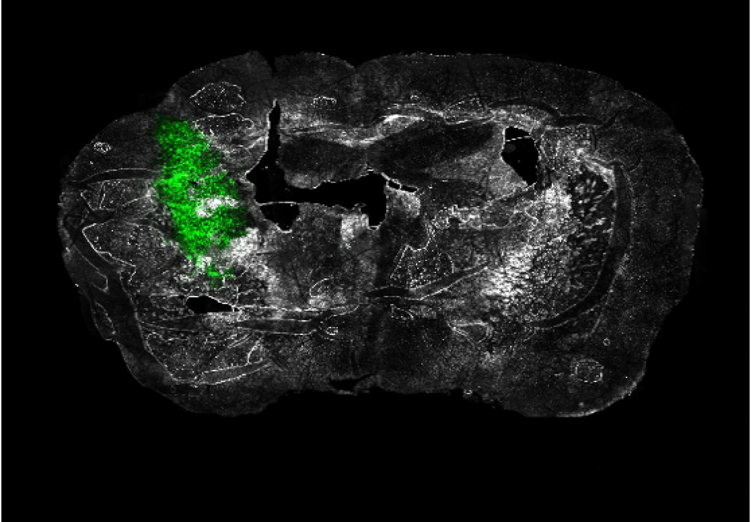 "Ex vivo coronal section of glioma cells, labeled with GFP (green), in a mouse model of glioblastoma (GBM) on day 14 of tumor development."